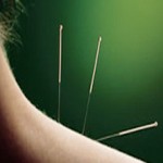 acupuncture