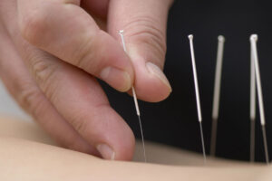Medical acupuncture treatment at Forest Hill Chiropractic and Massage Clinic in Toronto