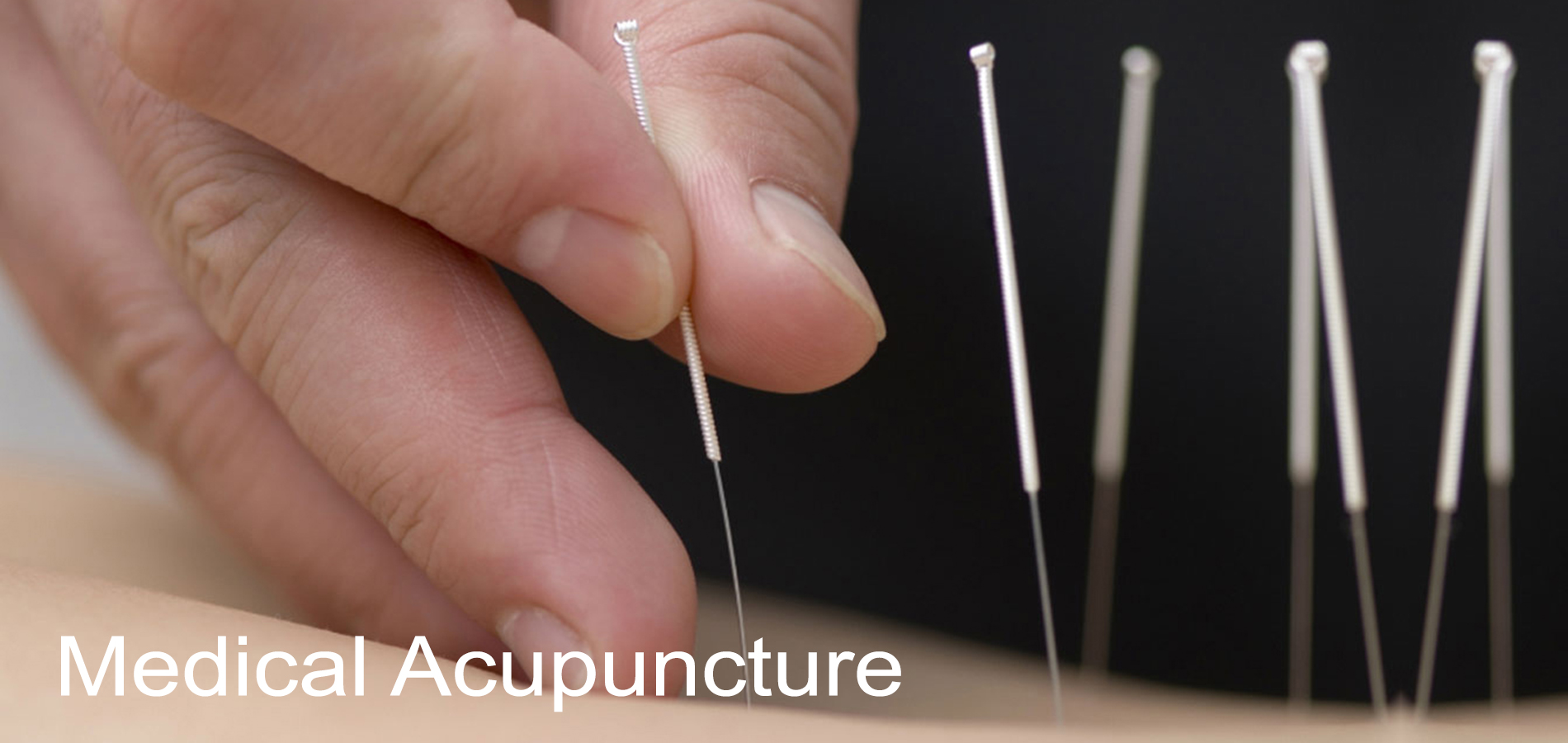 Medical acupuncture treatment at Forest Hill Chiropractic and Massage Clinic in Toronto